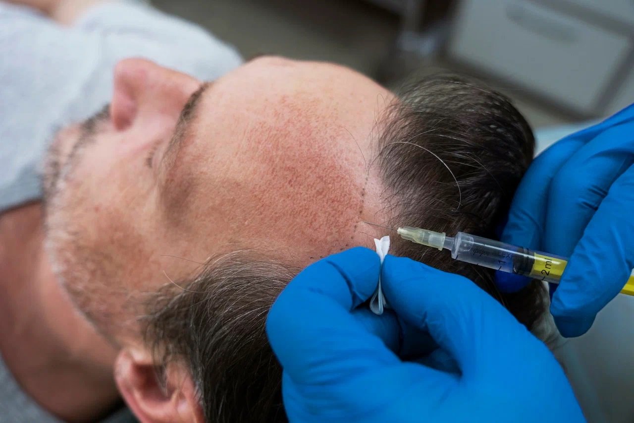 Are There Hidden Charges in Hair Transplant Cost in Islamabad?